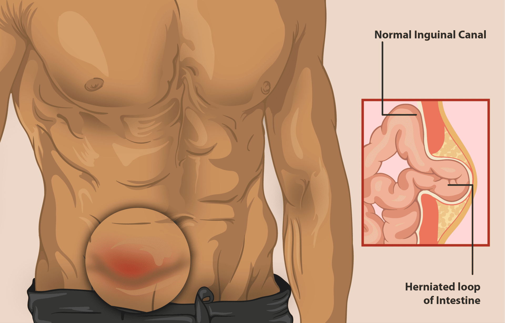 Inguinal Hernia treatment in Hyderabad